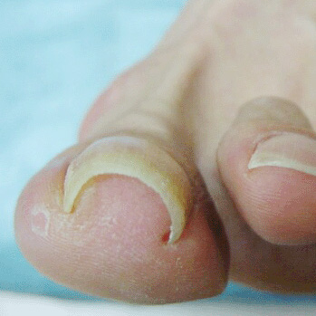足の親指の巻き爪