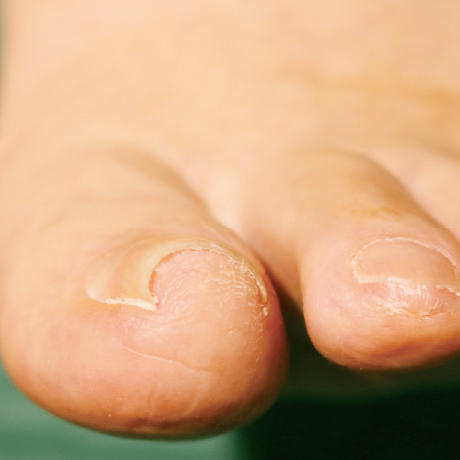 足の親指の巻き爪